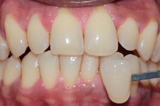 20230623_192648_0000 | Dental Krafts