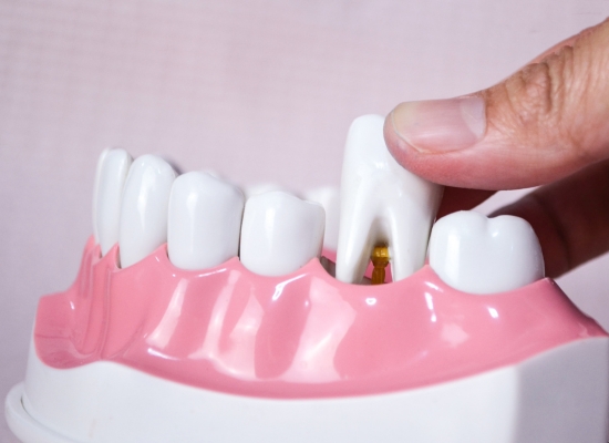 Untitled design (10) | Dental Krafts
