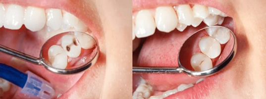 Benefits of Cosmetic Filling Treatment | Dental Krafts