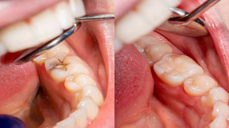 Cosmetic Filling Treatment in Govandi, Mumbai | Dental Krafts