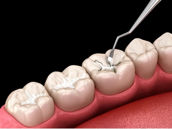 Cost of Cosmetic Filling Treatment in Govandi, Mumbai | Dental Krafts
