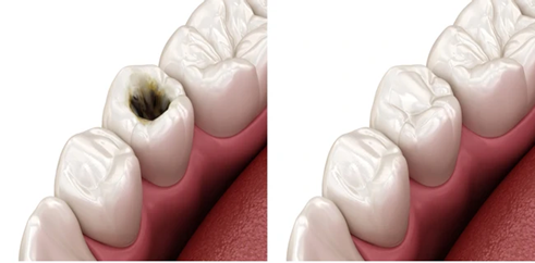 What Is Cosmetic Filling Treatment | Dental Krafts