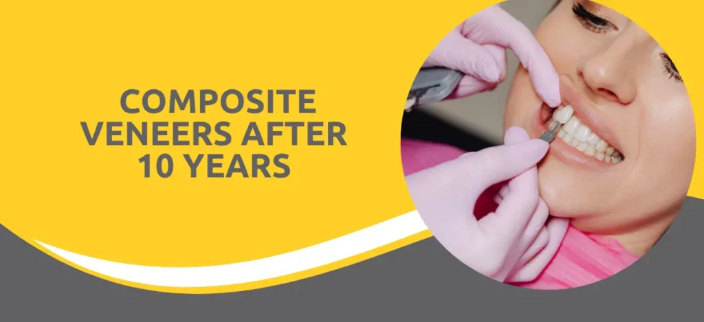 Composite_Veneers_After_10_Years | Dental Krafts Composite_Veneers_After_10_Years