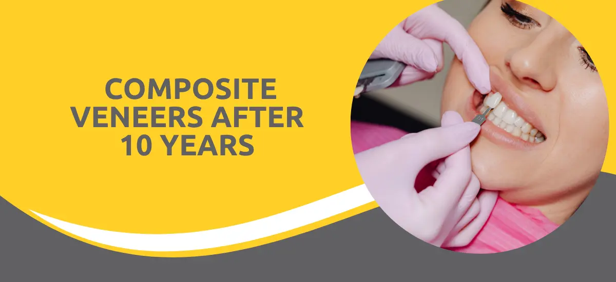Composite_Veneers_After_10_Years