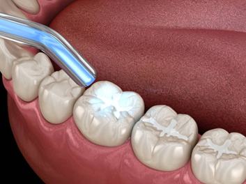 Picture4 | Dental Krafts