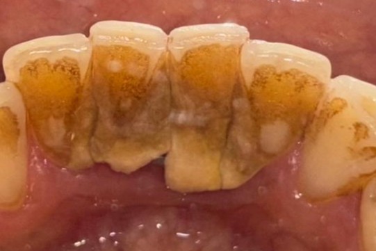 cavity cleaining-1before_ | Dental Krafts