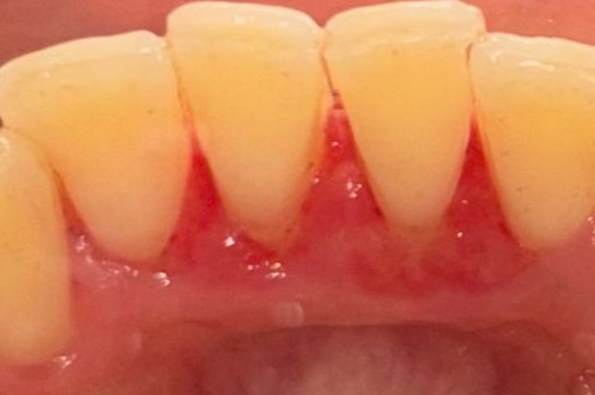 cavity cleaining-after | Dental Krafts