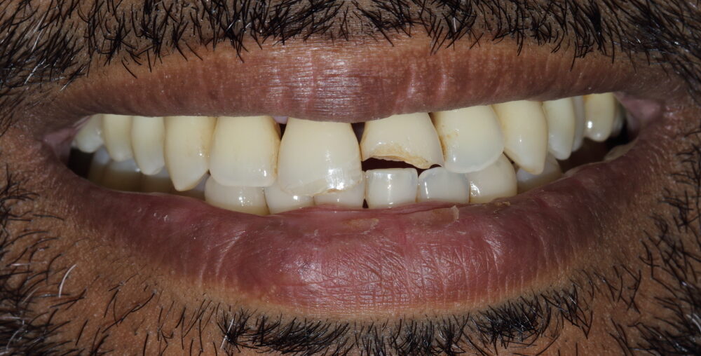 smile designing _ before | Dental Krafts