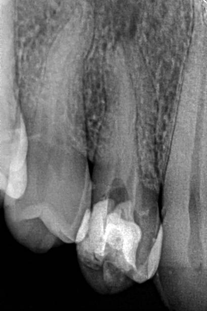 Key Reasons Throbbing Persists | Dental Krafts Key Reasons Throbbing Persists